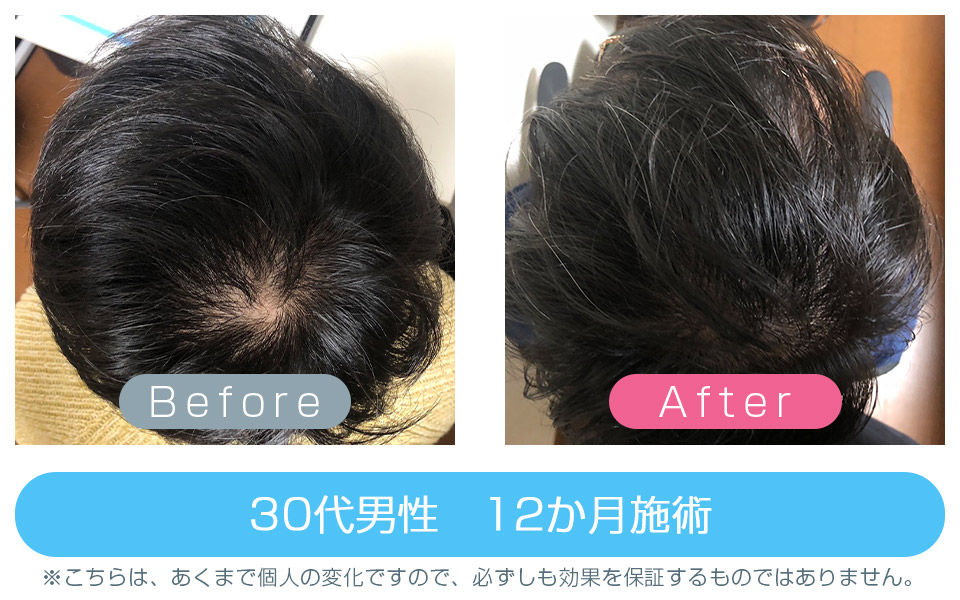発毛改善事例