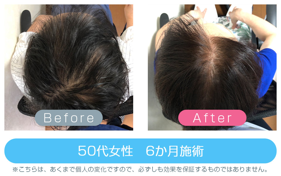 発毛改善事例