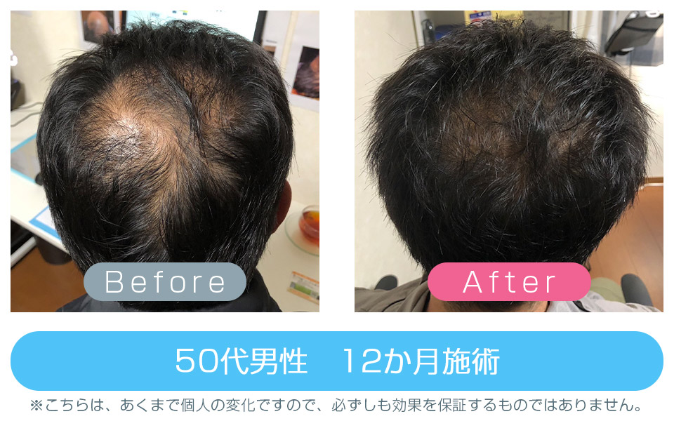 発毛改善事例